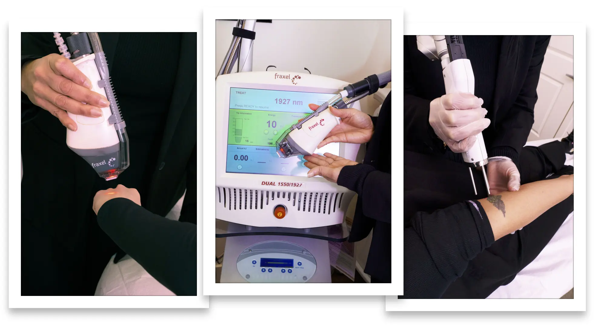 Various technologies for esthetic skin treatments including Fraxel